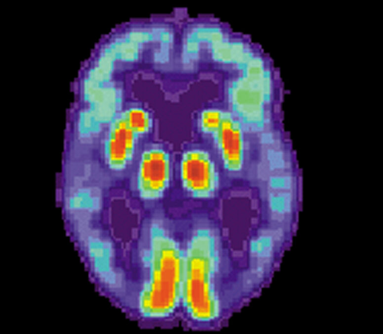 C’è un legame tra l’Alzheimer e gli ormoni sessuali