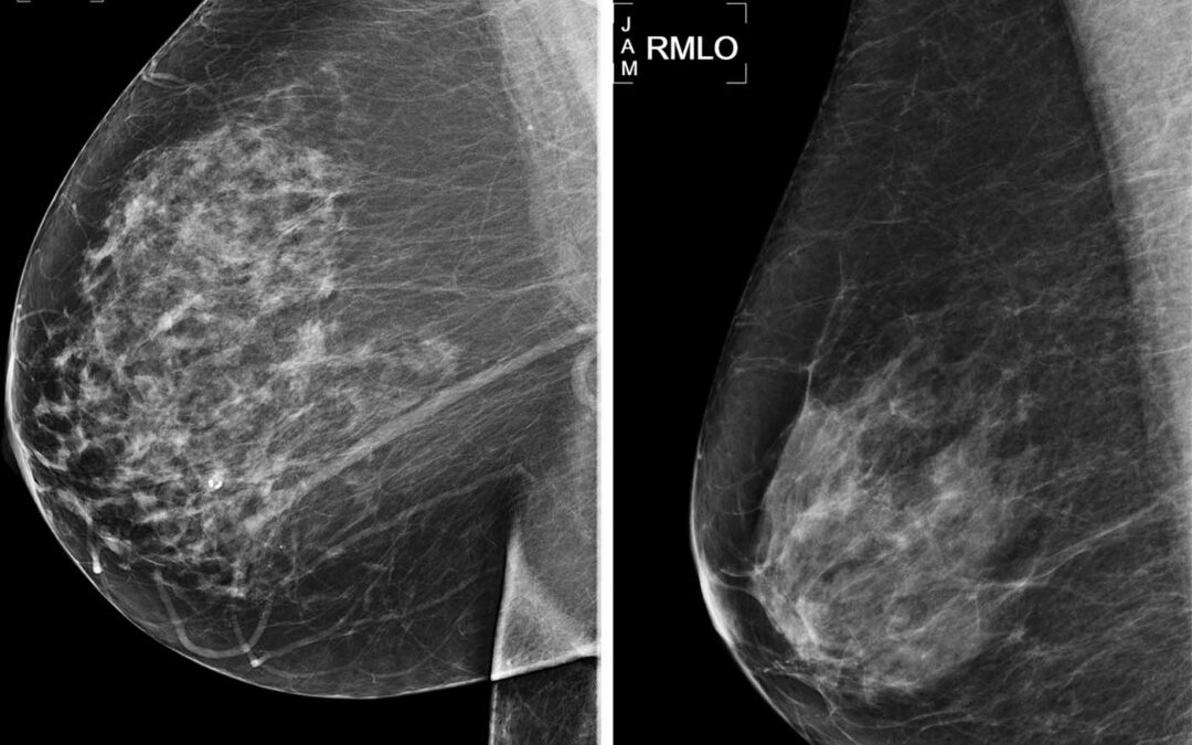 Tumori: chirurgia sempre meno invasiva per quello al seno