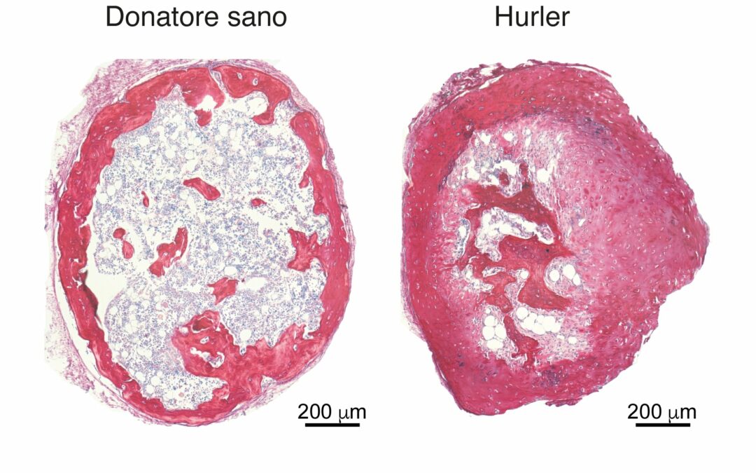 Fondazione Tettamanti e Sapienza: ricercatori creano per la prima volta organoide di osso per malattie rare