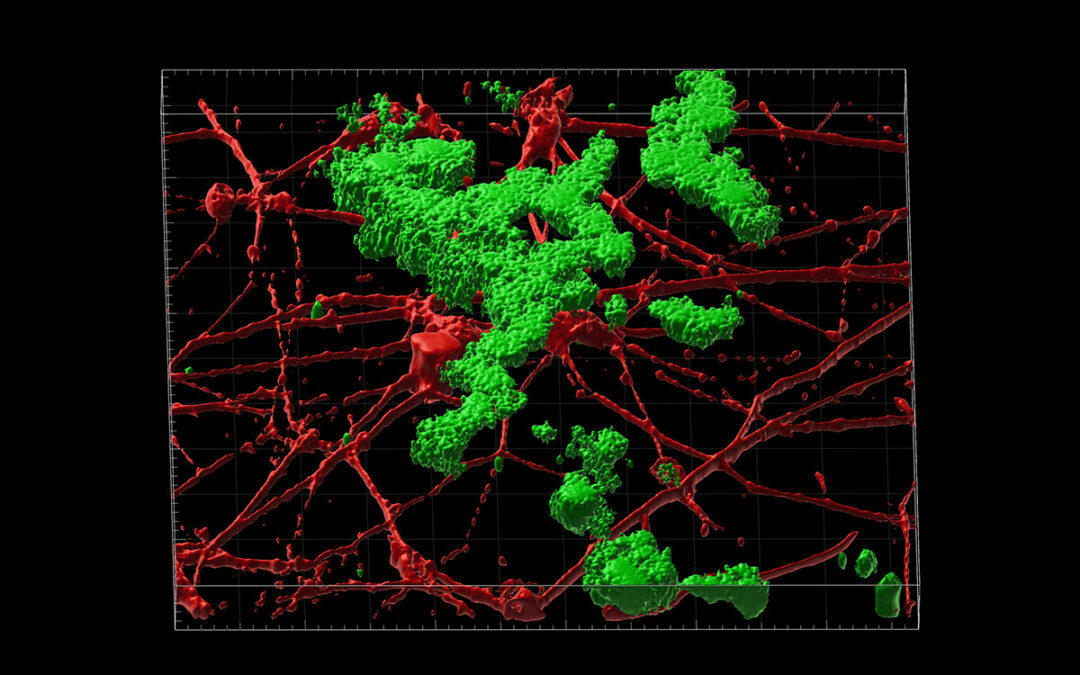 Alzheimer a esordio tardivo (ma non ereditario) potrebbe essere trattato con intervento precoce