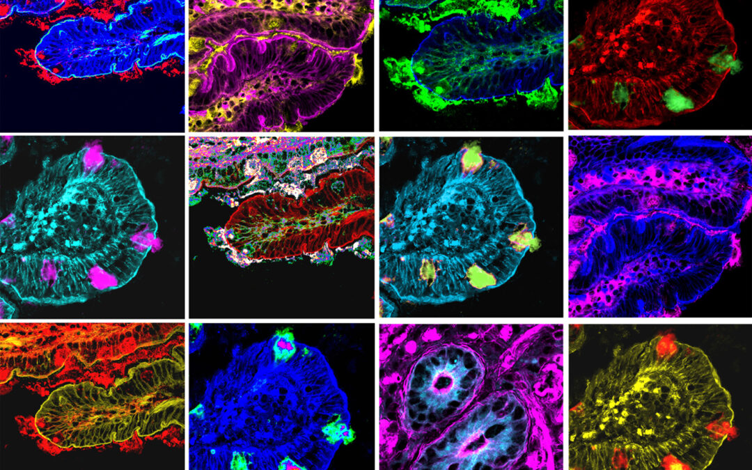 Emicrania, team Bambino Gesù scopre impronte nel cervello e nell’intestino dei bambini