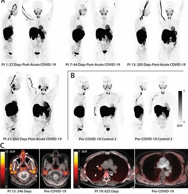 LONG-Covid, RNA virale e cellule T attive resistono per anni