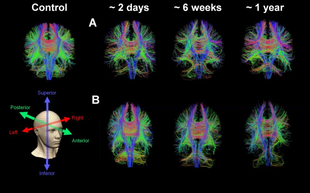 Le tecniche di imaging possono rilevare la ‘malattia nascosta’ dopo una commozione cerebrale
