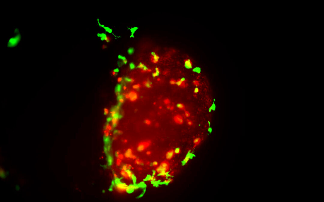 Vecchio vaccino elimina le cellule tumorali della vescica