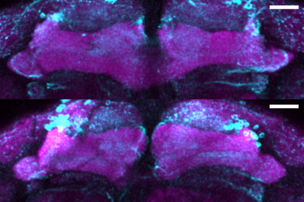 Nuova mutazione prevede il parkinsonismo precocemente