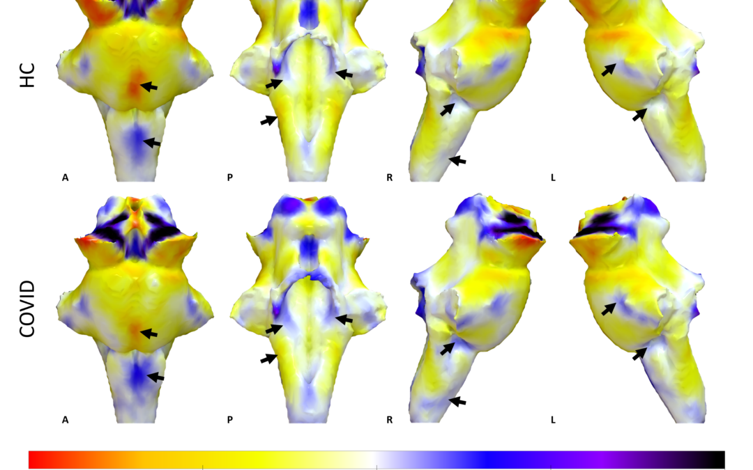 Il Covid lungo dipende dai danni al centro di controllo del cervello