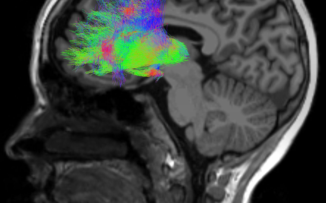 La schizofrenia è associata a un’attività cerebrale distinta