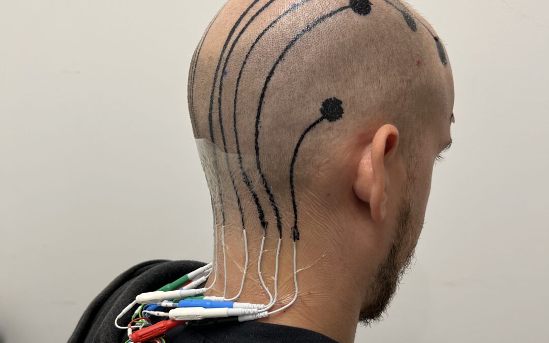 Un tatoo temporaneo sul cuoio capelluto misura le onde cerebrali