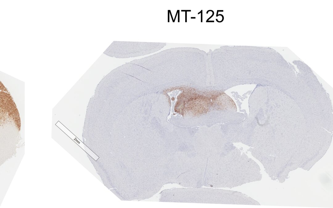 Tumori: nuovo farmaco rende sensibile a radio e chemio il glioblastoma e ferma le metastasi