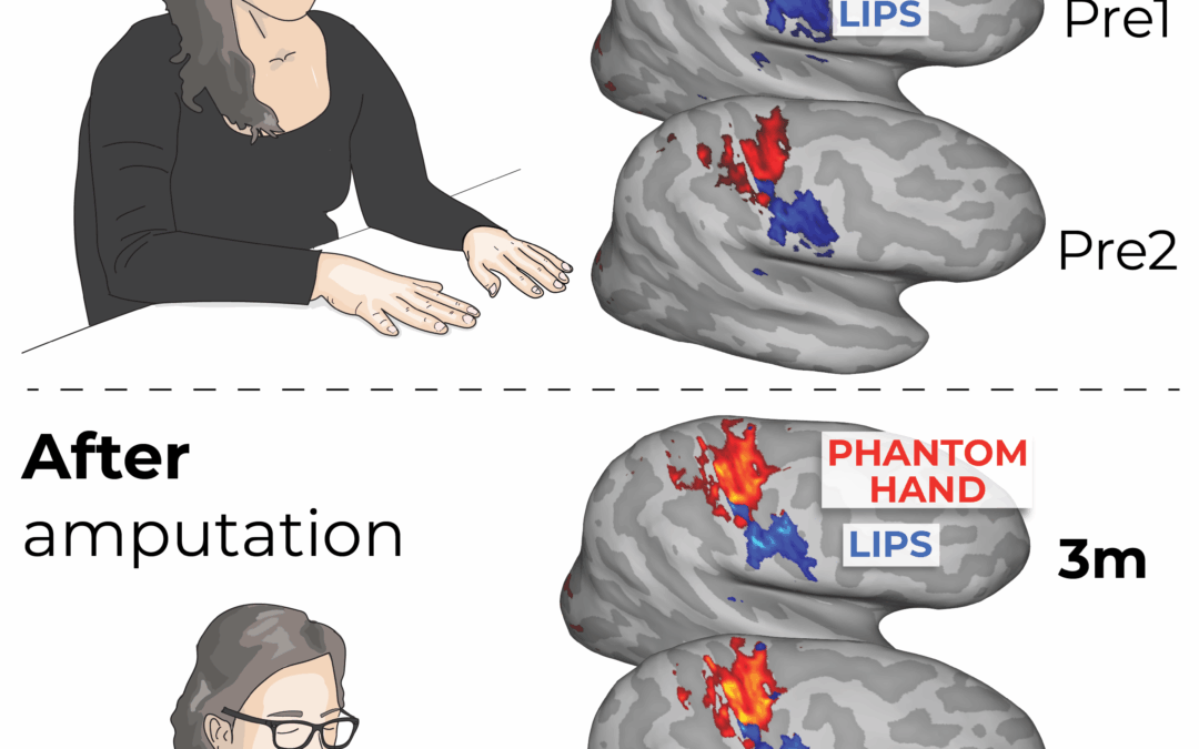 Contrordine: il cervello non si riorganizza dopo un’amputazione
